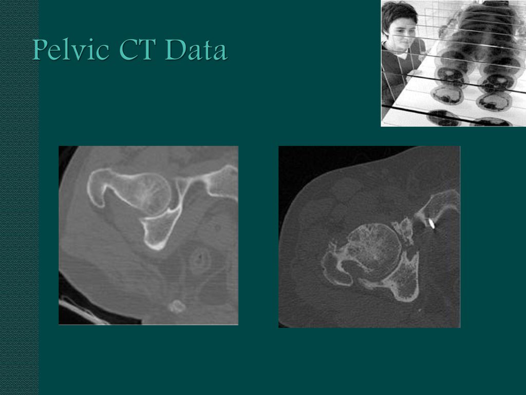 Pelvic CT Data CT scanning offers an feasible way to diagnose it.
