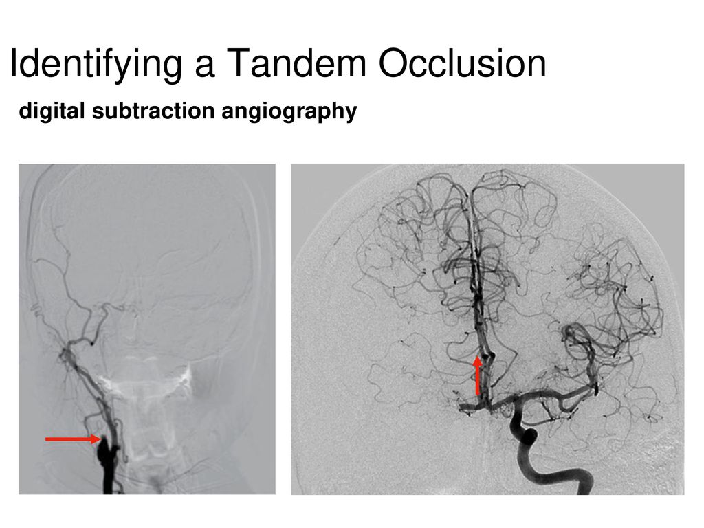 Carotid Stenting In Acute Ischemic Stroke Resulting From Tandem ...