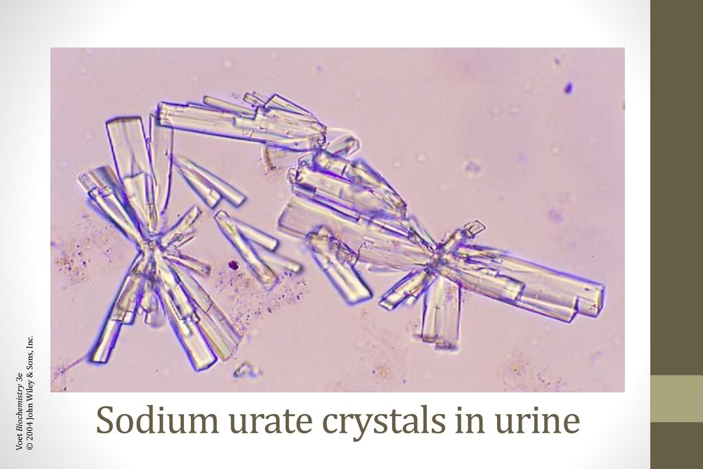 sodium urate in urine