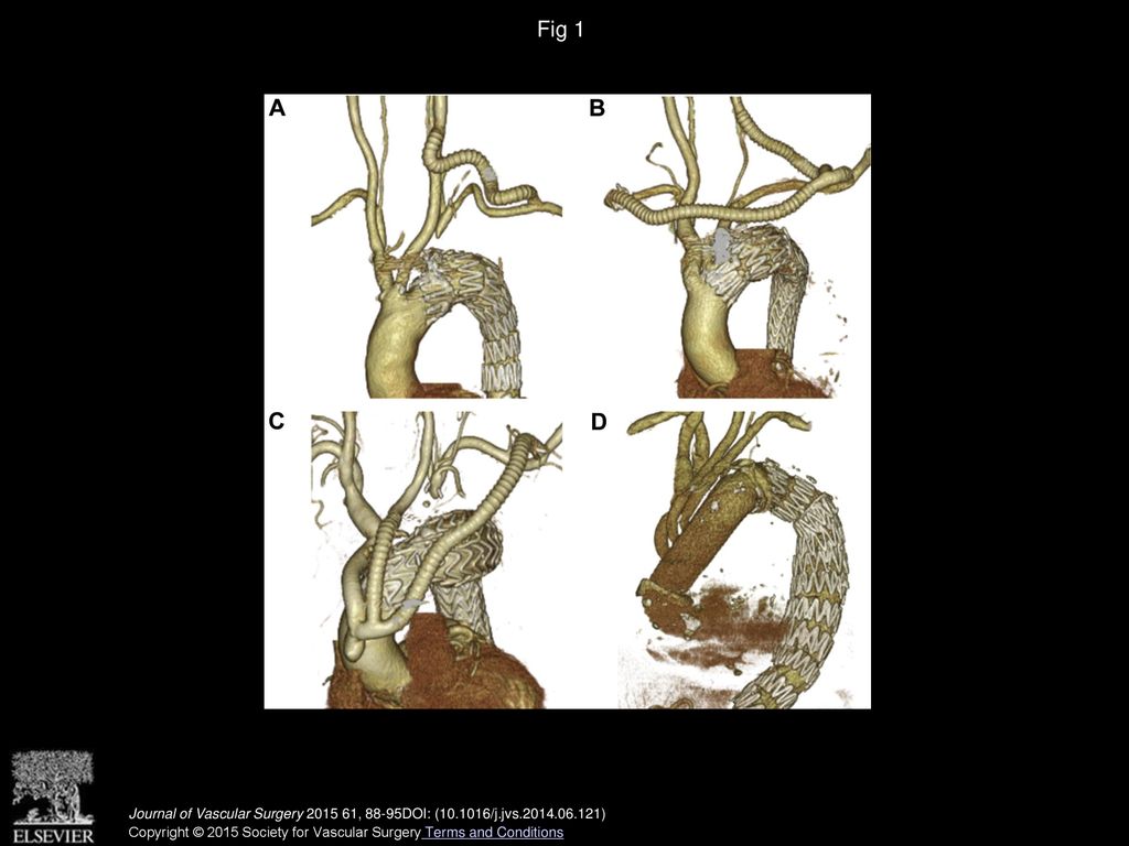 Clinical Outcomes Of Different Approaches To Aortic Arch Disease - Ppt ...