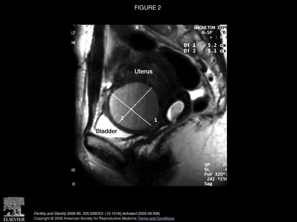FIGURE 2 MRI of pelvis. Median sagittal T2-weighted scan.