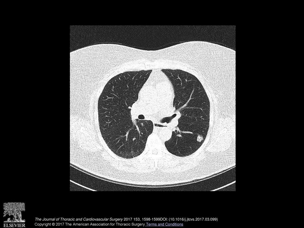 Small peripheral lung nodules: Are they always lung cancer