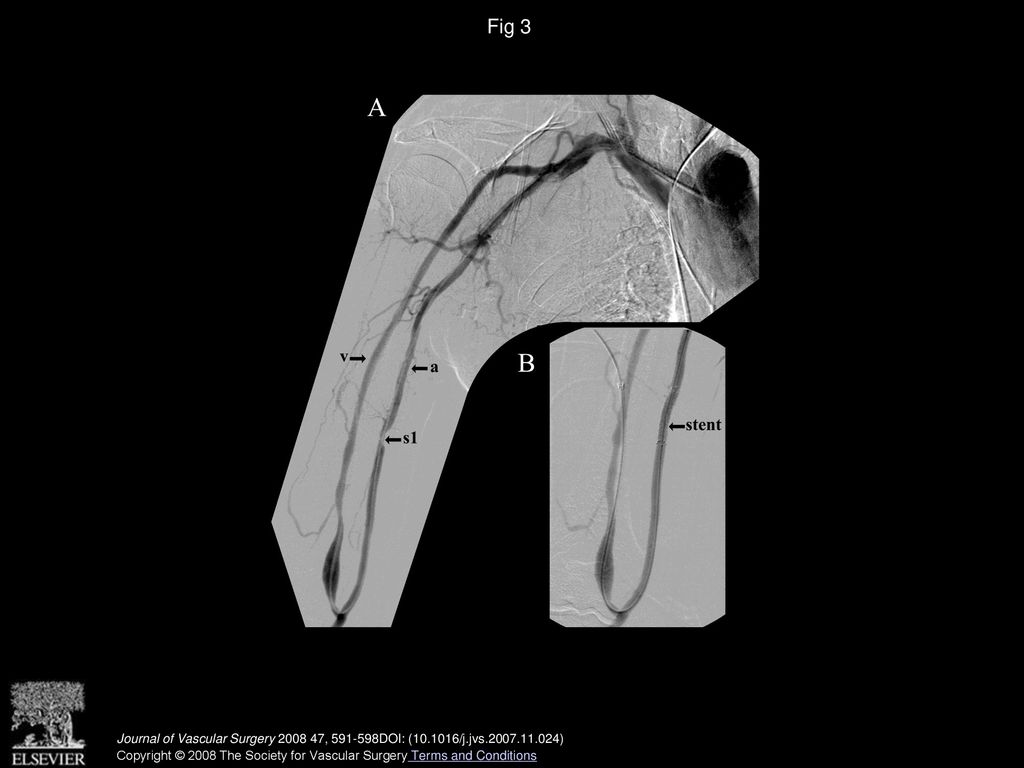 Outpatient Treatment Of Arterial Inflow Stenoses Of Dysfunctional stent-placement-process-and-post-operative-care