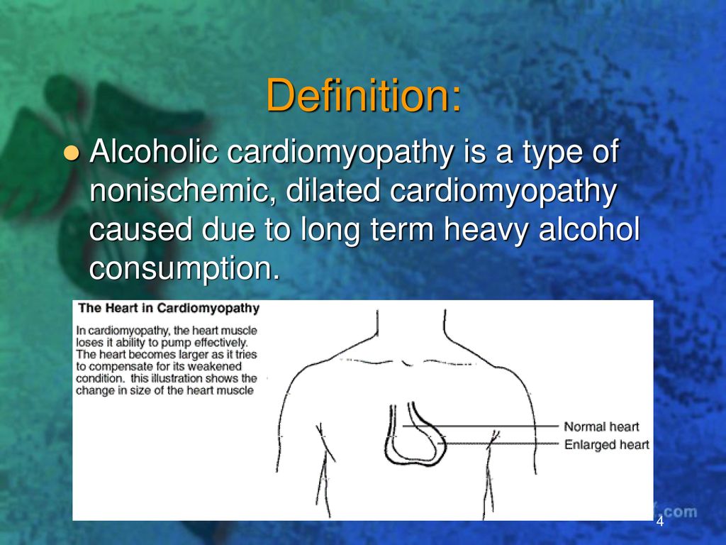 Alcoholic Cardiomyopathy A K A Acm Ppt Download