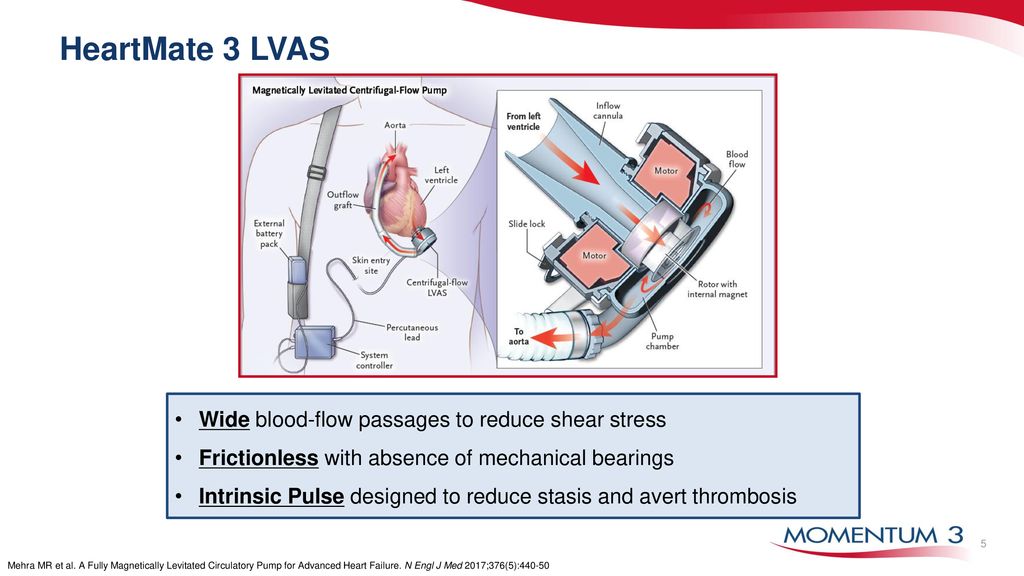 HeartMate 3 LVAS Wide blood-flow passages to reduce shear stress