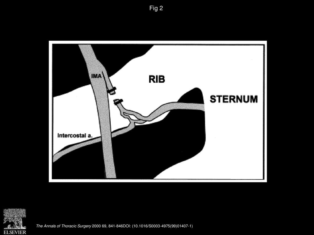Fig 2 Collateral blood flow to the sternum is preserved after division of internal mammary artery side branches.