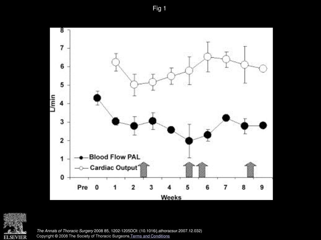 Bridge To Lung Transplantation Through A Pulmonary Artery To Left 