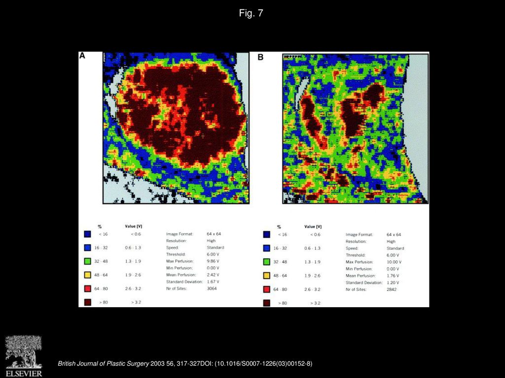 Efficacy of pulse dye laser therapy for the treatment of ulcerated ...