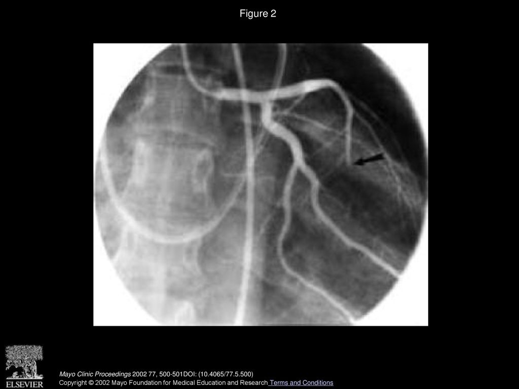Figure 2 Coronary angiogram showing occluded left anterior descending artery (arrow) and distal flow consistent with embolus.