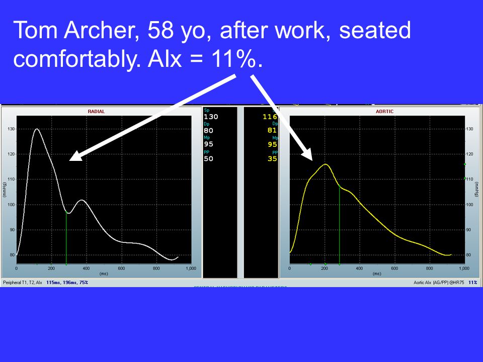Tom Archer, 58 yo, after work, seated comfortably. AIx = 11%.