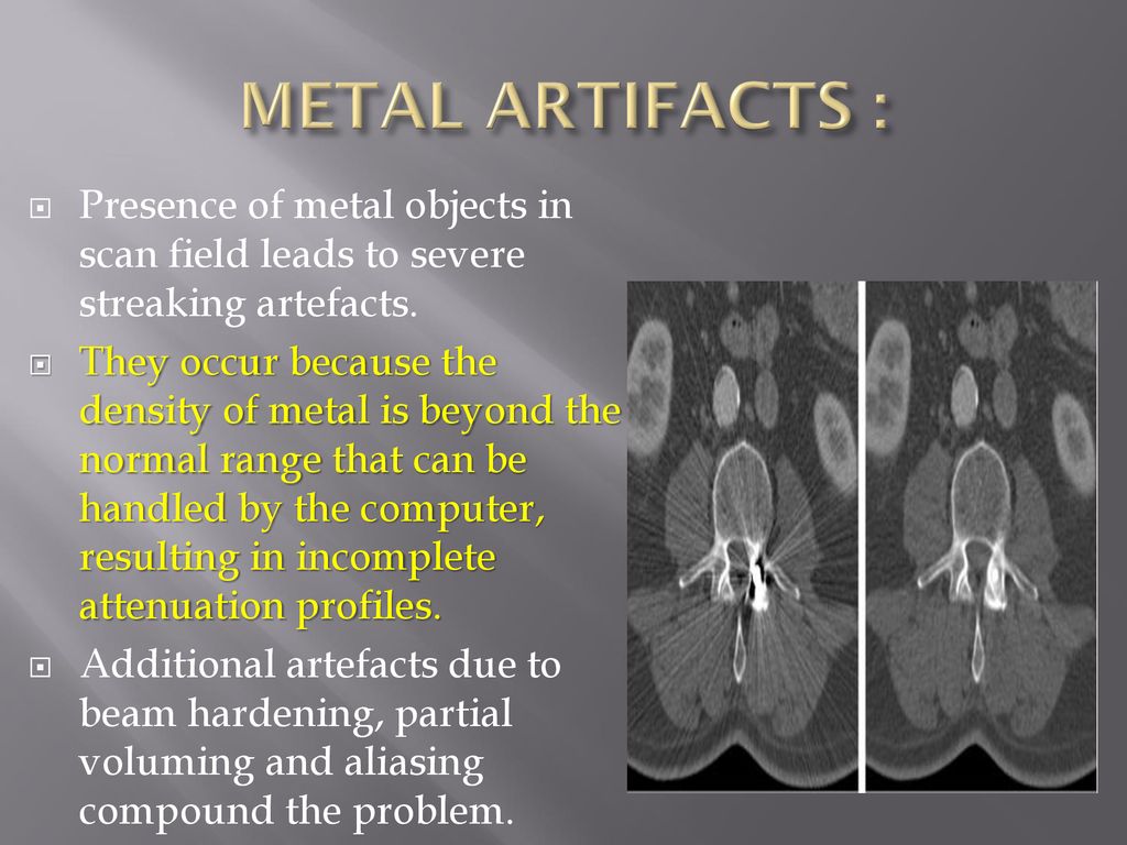 How to Recognize CT Artifacts and Minimize Them During Data Collection