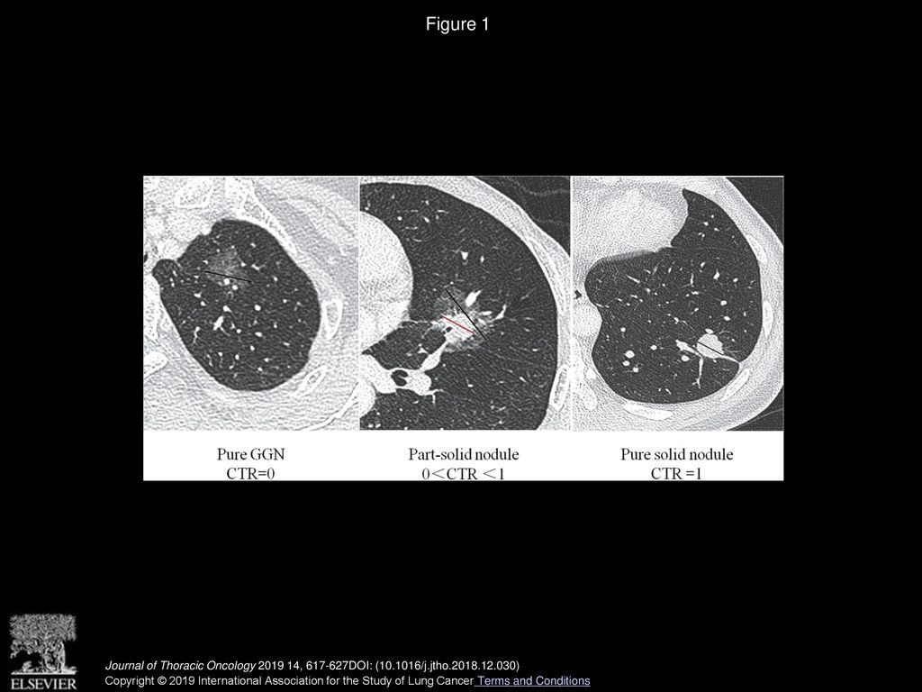 Lung Adenocarcinomas Manifesting as Radiological PartSolid Nodules