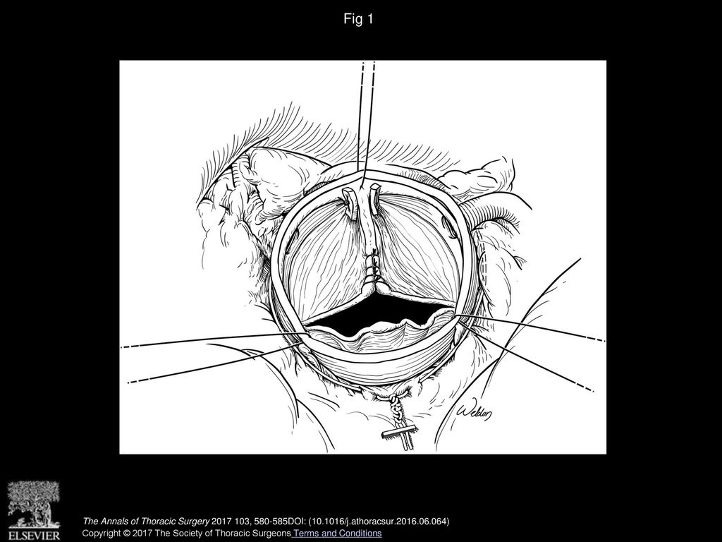 Sinus Plication to Improve Valve Configuration in Bicuspid Aortic Valve ...