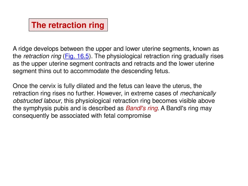 The Contraction Ring as a Cause of Dystocia, with a Description of a  Specimen Removed by Hysterectomy during Labour