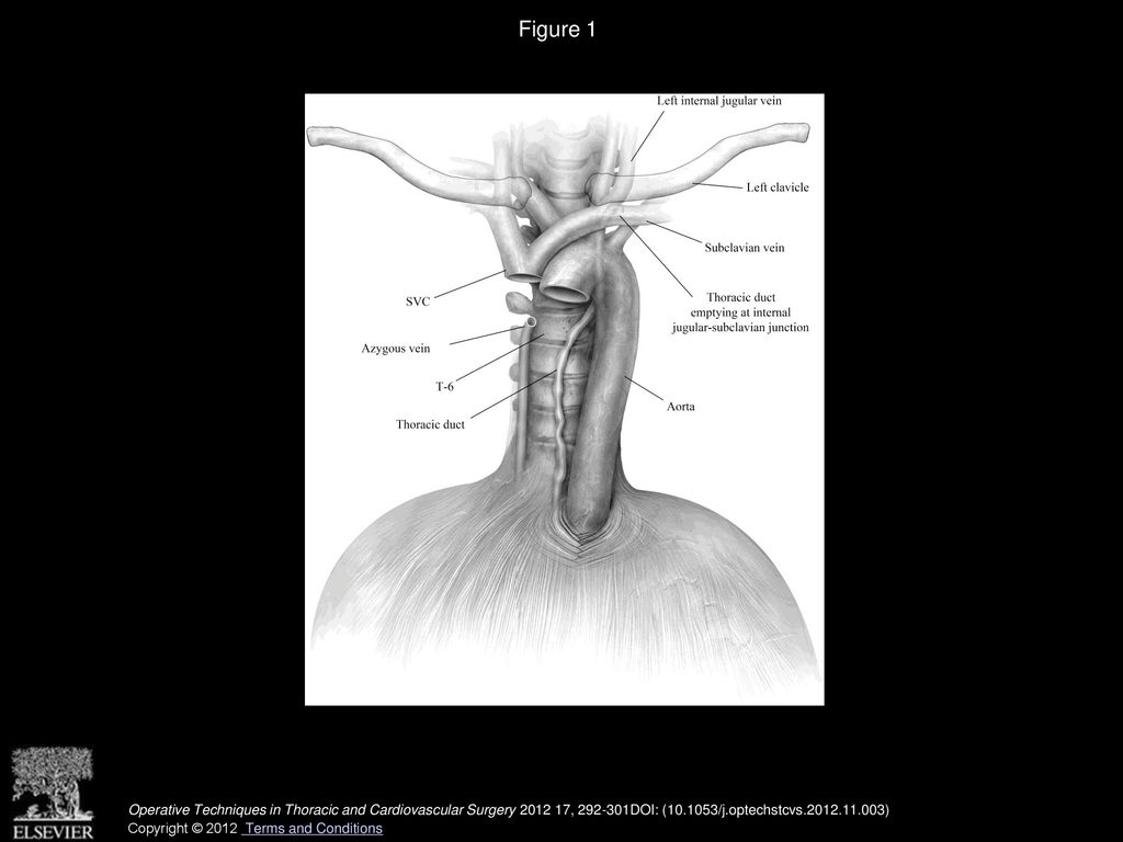 Thoracoscopic Thoracic Duct Ligation Ppt Download