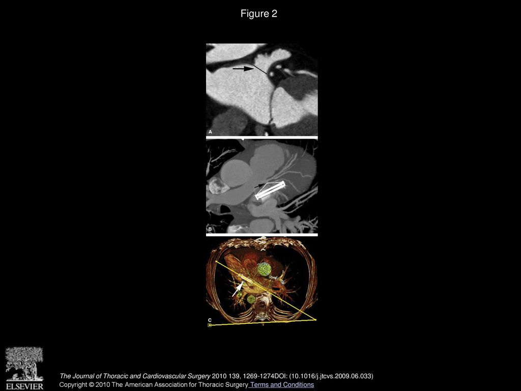 Left atrial appendage clip occlusion: Early clinical results - ppt download