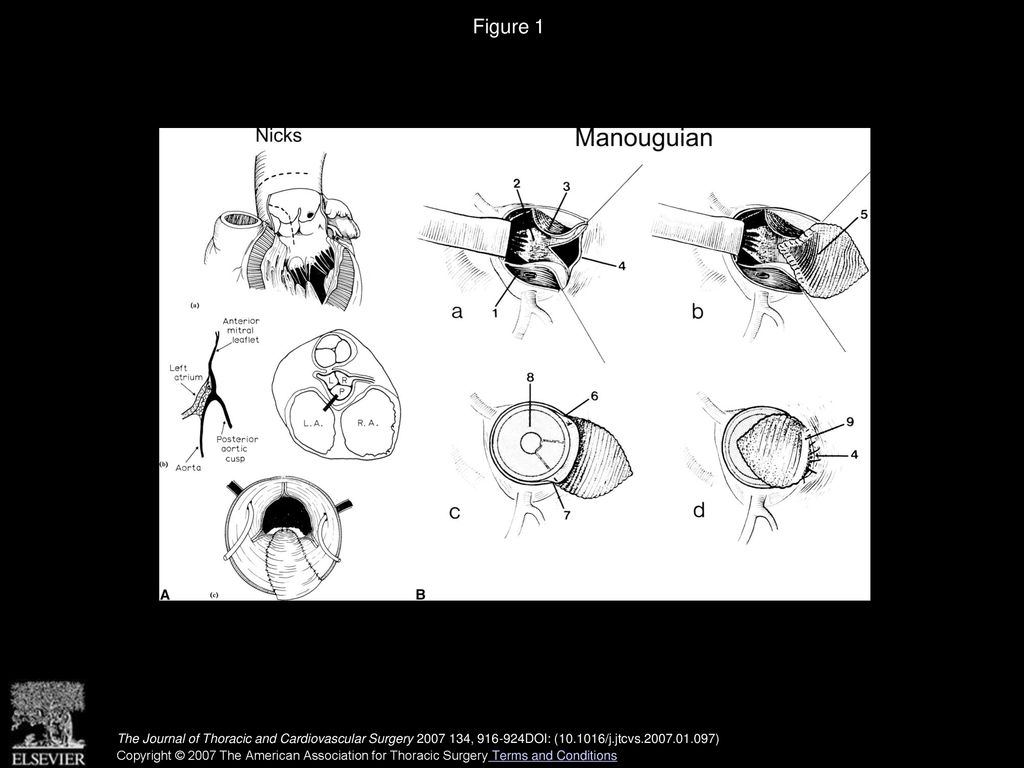 Aortic Root Enlargement What Are The Operative Risks Ppt Download