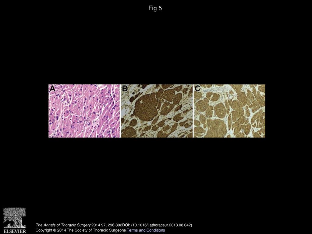 Novel Diagnosis And Treatment Of Esophageal Granular Cell Tumor Report