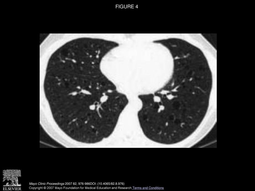 Diagnosis Of Interstitial Lung Diseases Ppt Download diagnosis-of-interstitial-lung-diseases-ppt-download