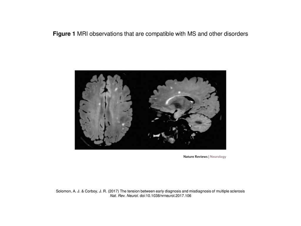 Nonspecific T2 Hyperintensities