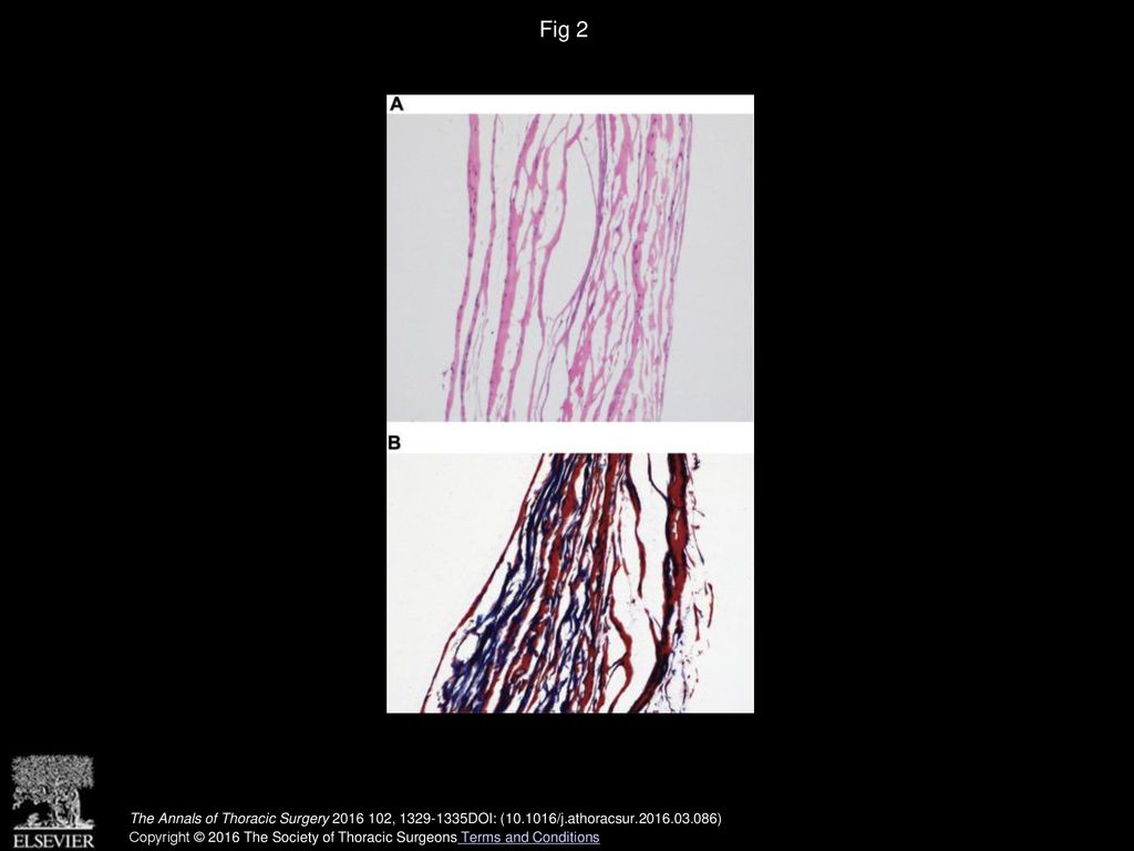 Evaluation of Explanted CorMatrix Intracardiac Patches in Children With ...