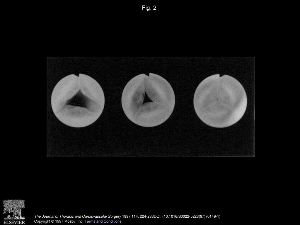 Use of a bovine jugular vein graft with natural valve for right ...