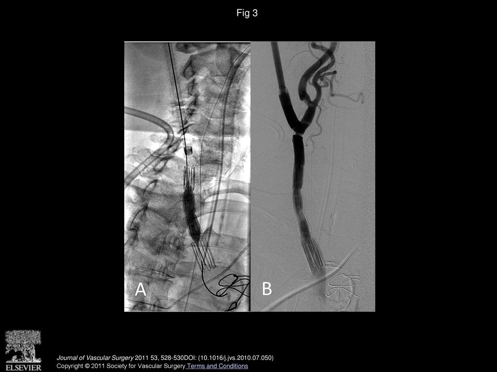 Hybrid management of proximal right subclavian artery aneurysms - ppt ...