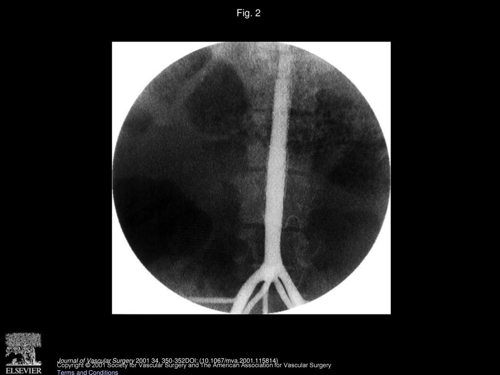 Fig. 2 Completion angiogram shows exclusion of aneurysm without evidence of endoleak.