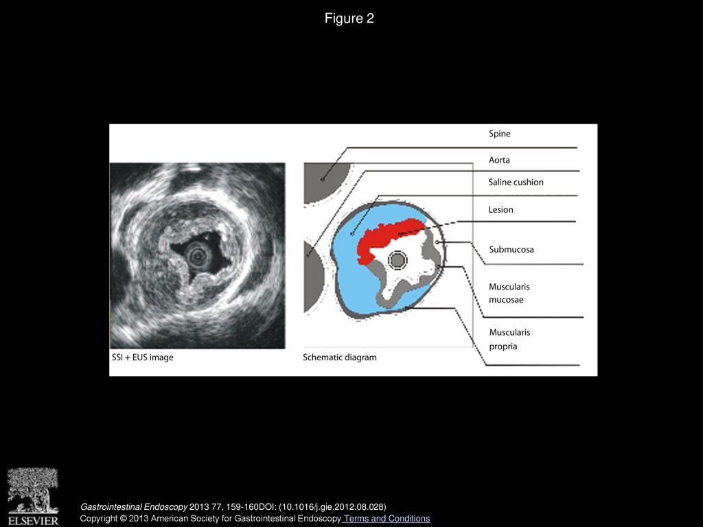 Submucosal saline solution injection combined with endosonography for