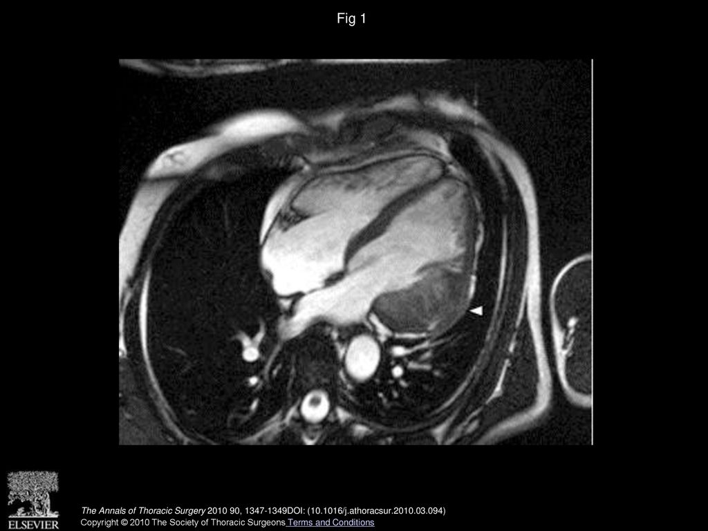 Intractable ventricular tachycardia secondary to cardiac hemangioma
