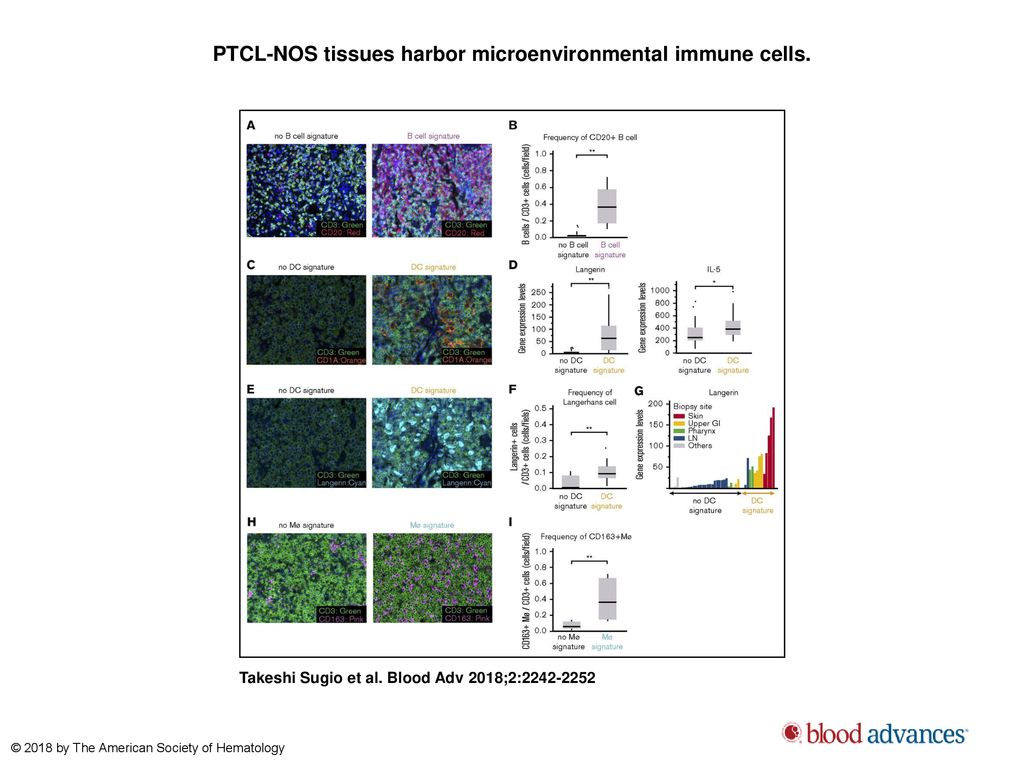 PTCL-NOS tissues harbor microenvironmental immune cells.
