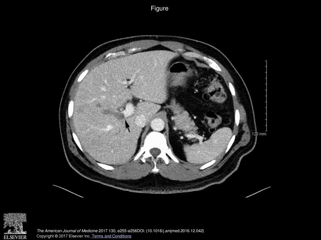 Figure Computed tomography of the abdomen showing portal vein thrombosis (arrow).