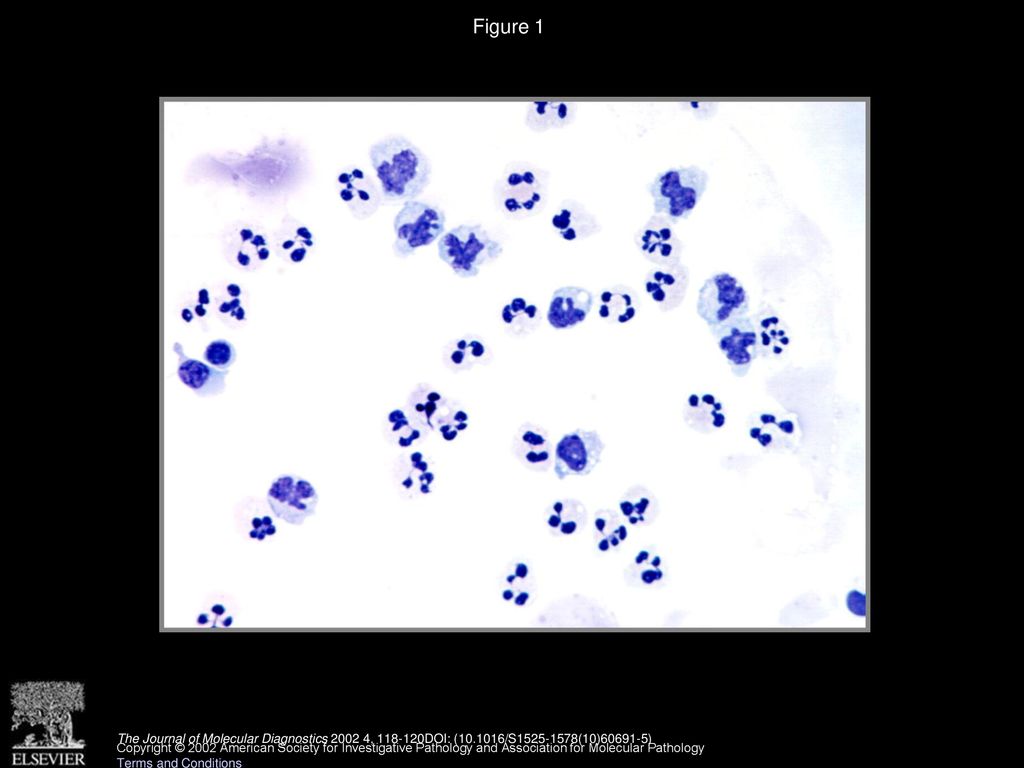 Figure 1 CSF specimen demonstrating an admixture of neutrophils, monocytes, and non-atypical lymphocytes (Wright magnification, ×100).