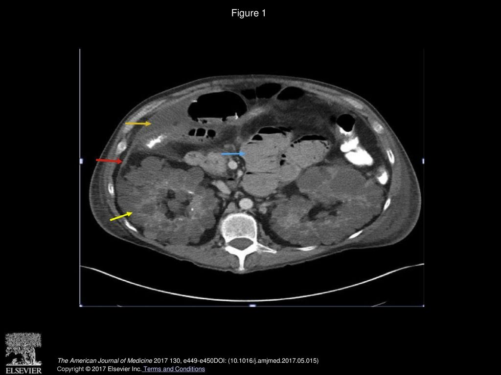 Long-Term Peritoneal Dialysis May Result in Vascular Changes Within the ...