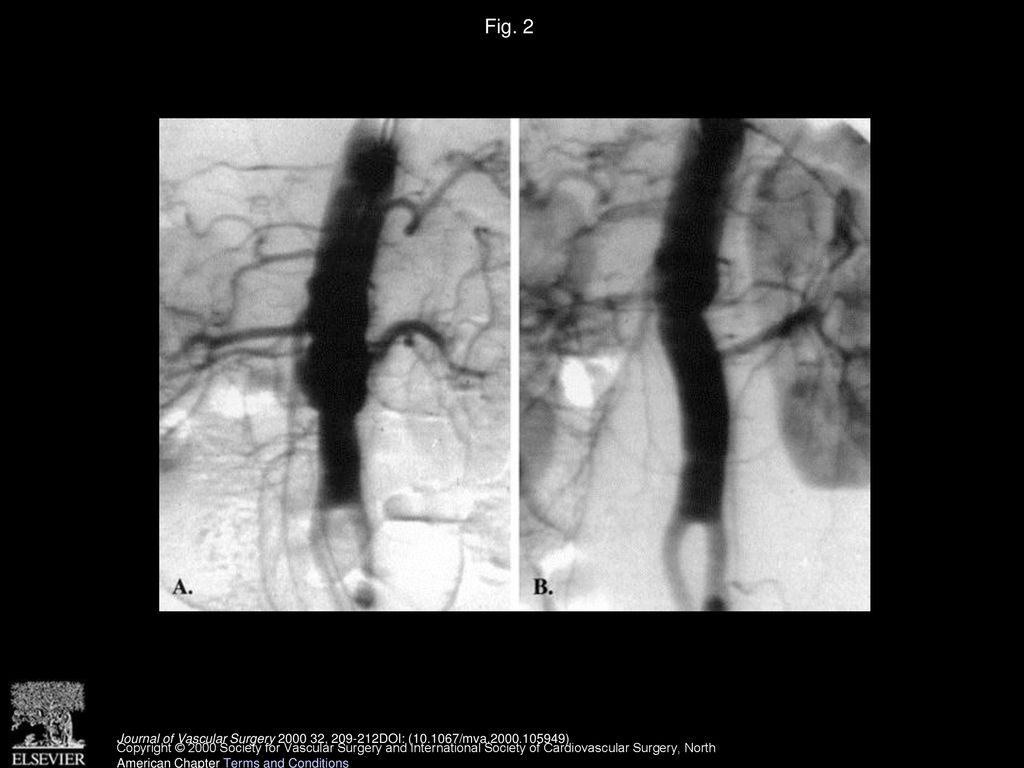 Surgical treatment of recurrent abdominal aortic aneurysm in a patient ...