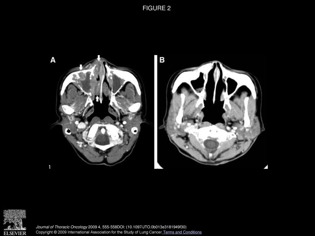 Nasion Swelling as the Presenting Symptom of Lung Adenocarcinoma - ppt ...