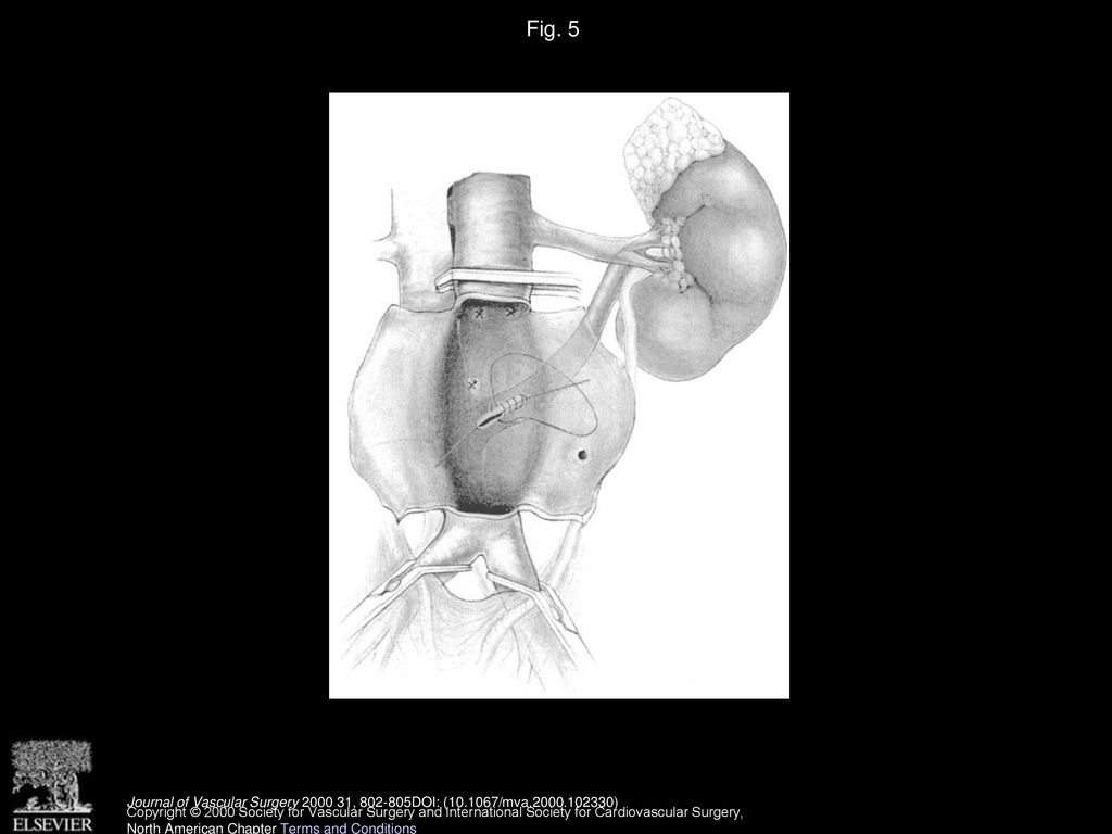 Fig. 5 Repair of ALRVF through the posterior aneurysm wall. Sponge sticks establishing control of the fistula have been omitted for clarity.