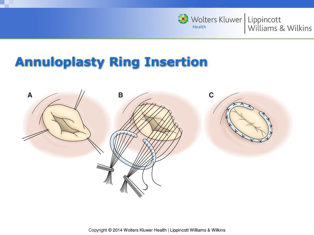 Annuloplasty Ring Insertion