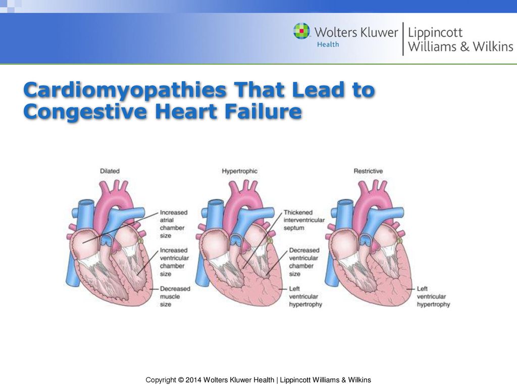 Cardiomyopathies That Lead to Congestive Heart Failure