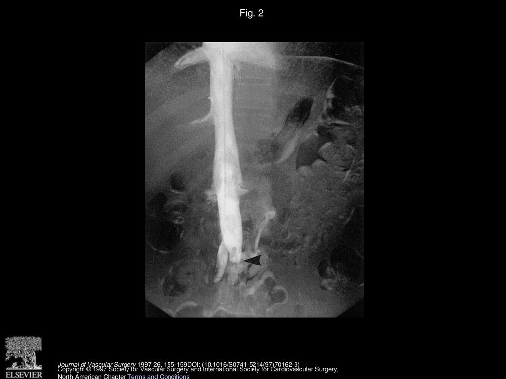 Fig. 2 Reconstituted inferior vana cava. Note the Greenfield filter at the inferior portion (arrow).