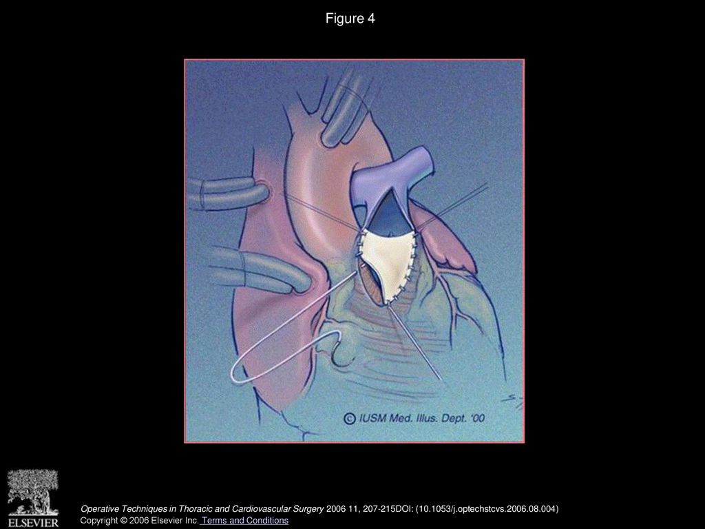 Biologic versus Mechanical Valve Replacement of the Pulmonary Valve ...