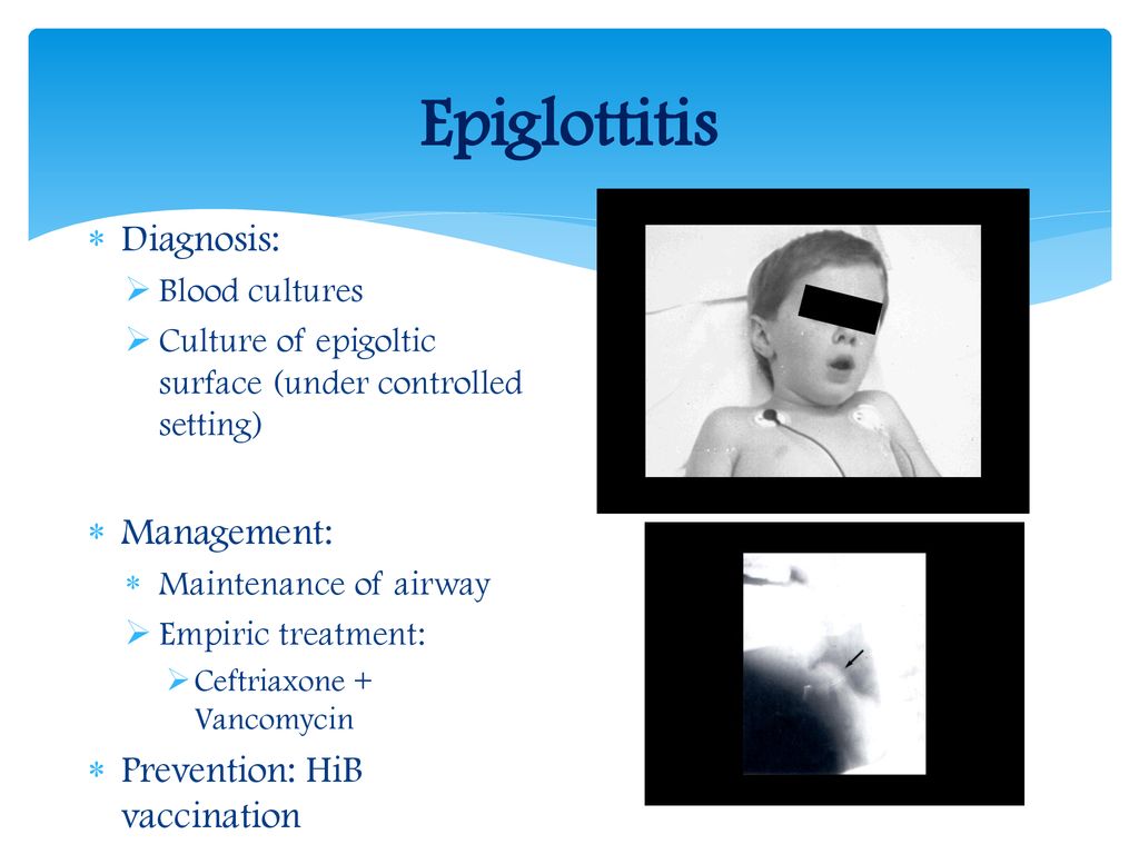 Epiglottitis Diagnosis: Management: Prevention: HiB vaccination