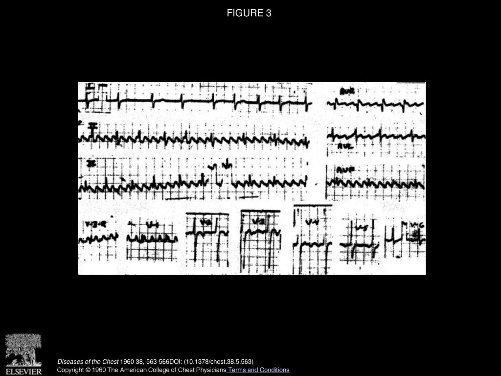 Atrial flutter with 1 1 a v conduction ppt download