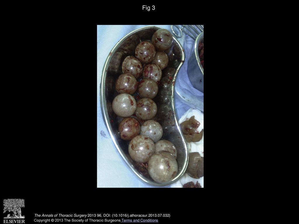 Fig 3 The Annals of Thoracic Surgery , DOI: ( /j.athoracsur )