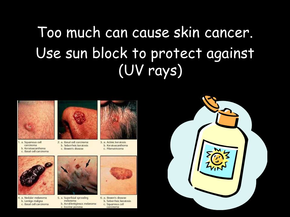 Too much can cause skin cancer.