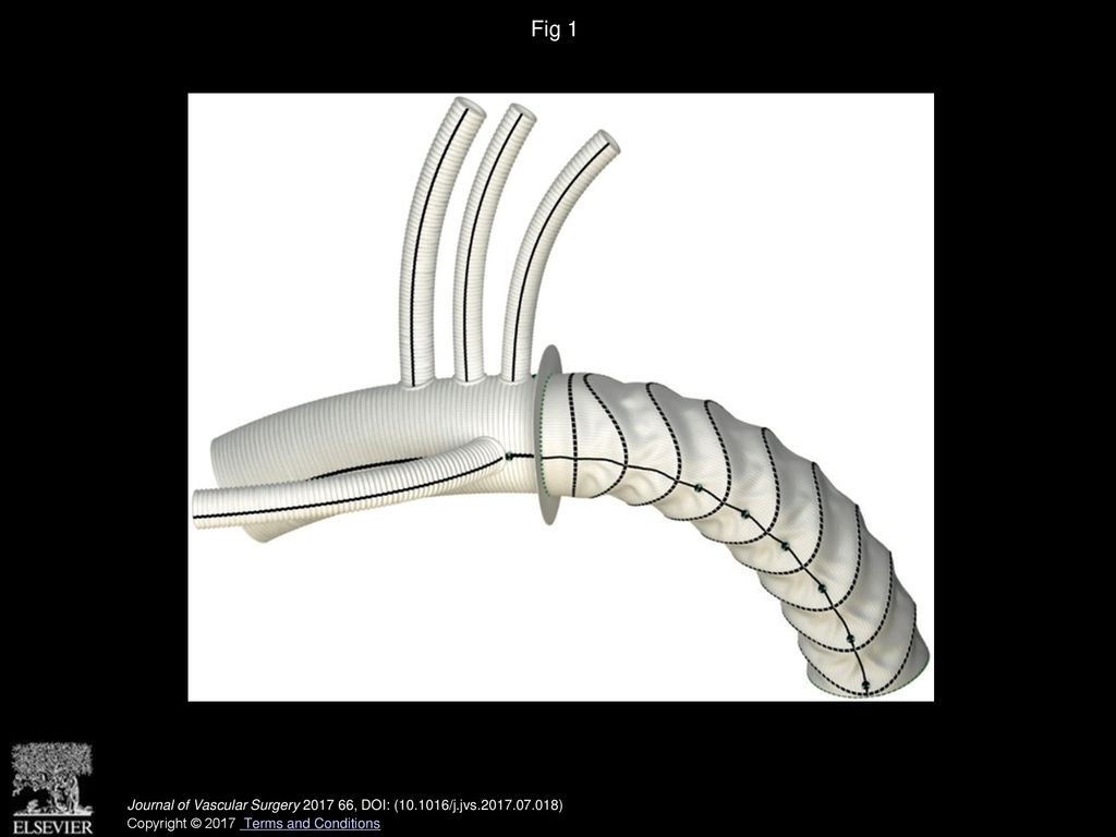 Thoraflex Hybrid Endovascular Frozen Elephant Trunk Device for