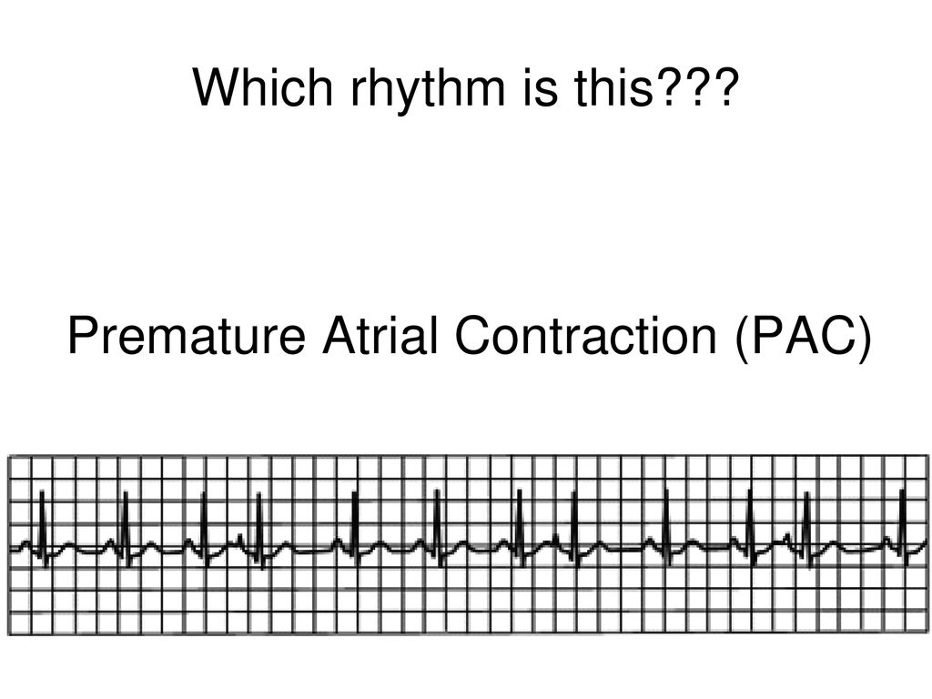 Review Of Ecgs Ppt Download Review Of Ecgs Ppt Download