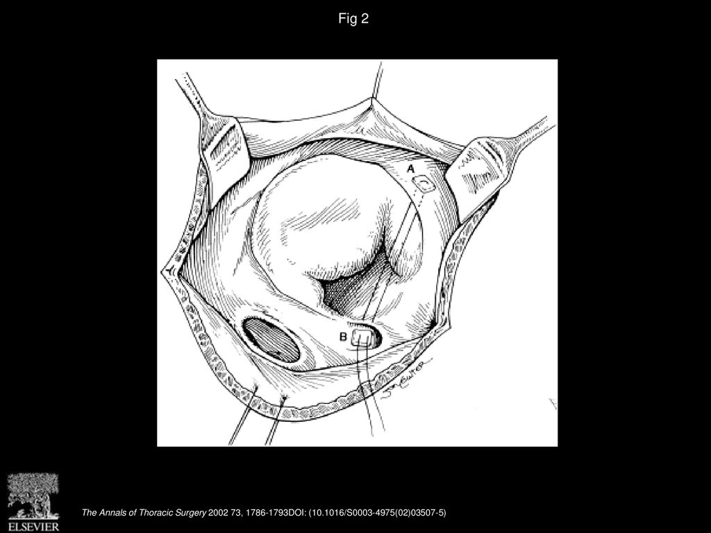 Repair of Ebstein’s anomaly in the symptomatic neonate: an evolution of ...