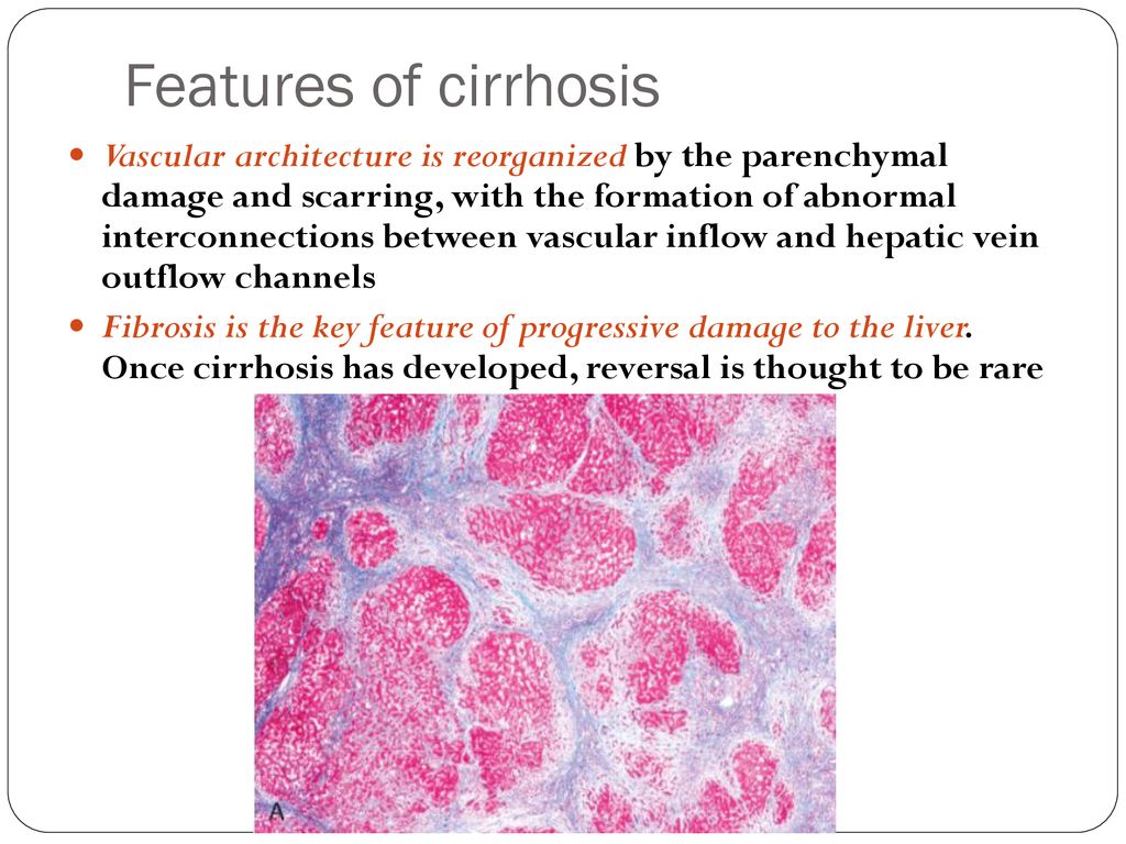 Liver Cirrhosis. - ppt download