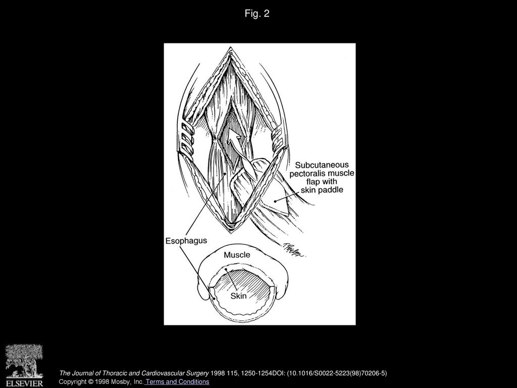 The Utility Of The Pectoralis Myocutaneous Flap In The Management Of